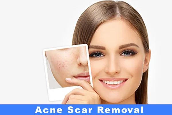 Acne Scar Removal