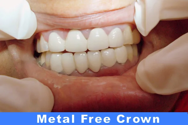 Metal Free Crown & Bridge