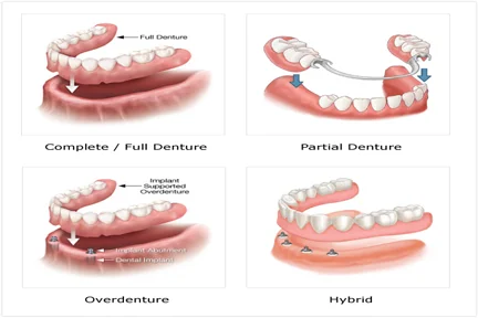 Fixed & Removable Dentures