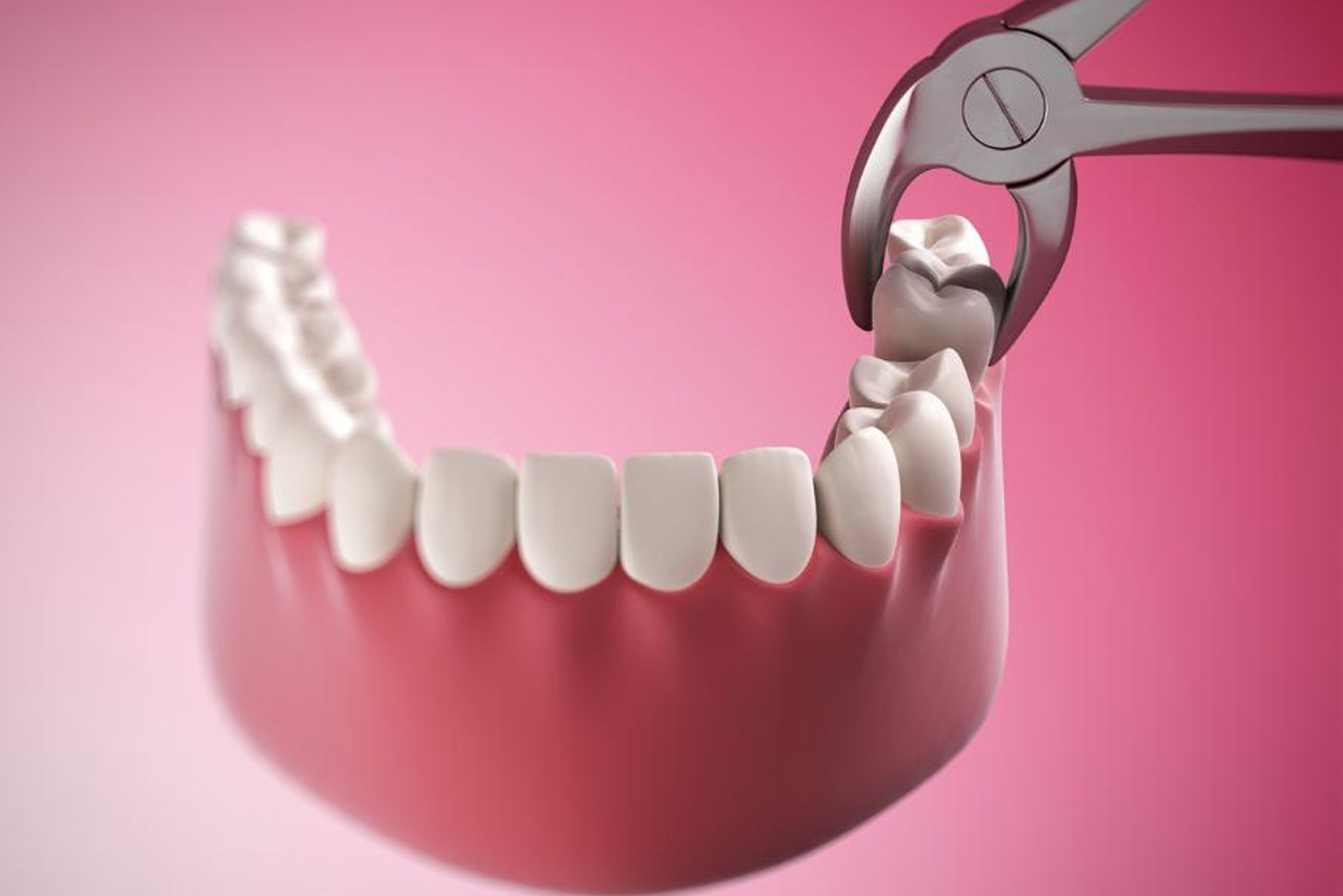 Surgical Extractions