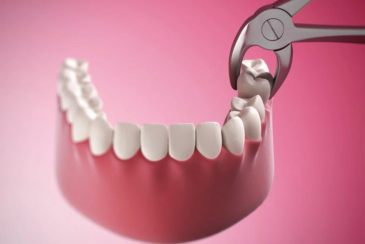 Surgical Extractions