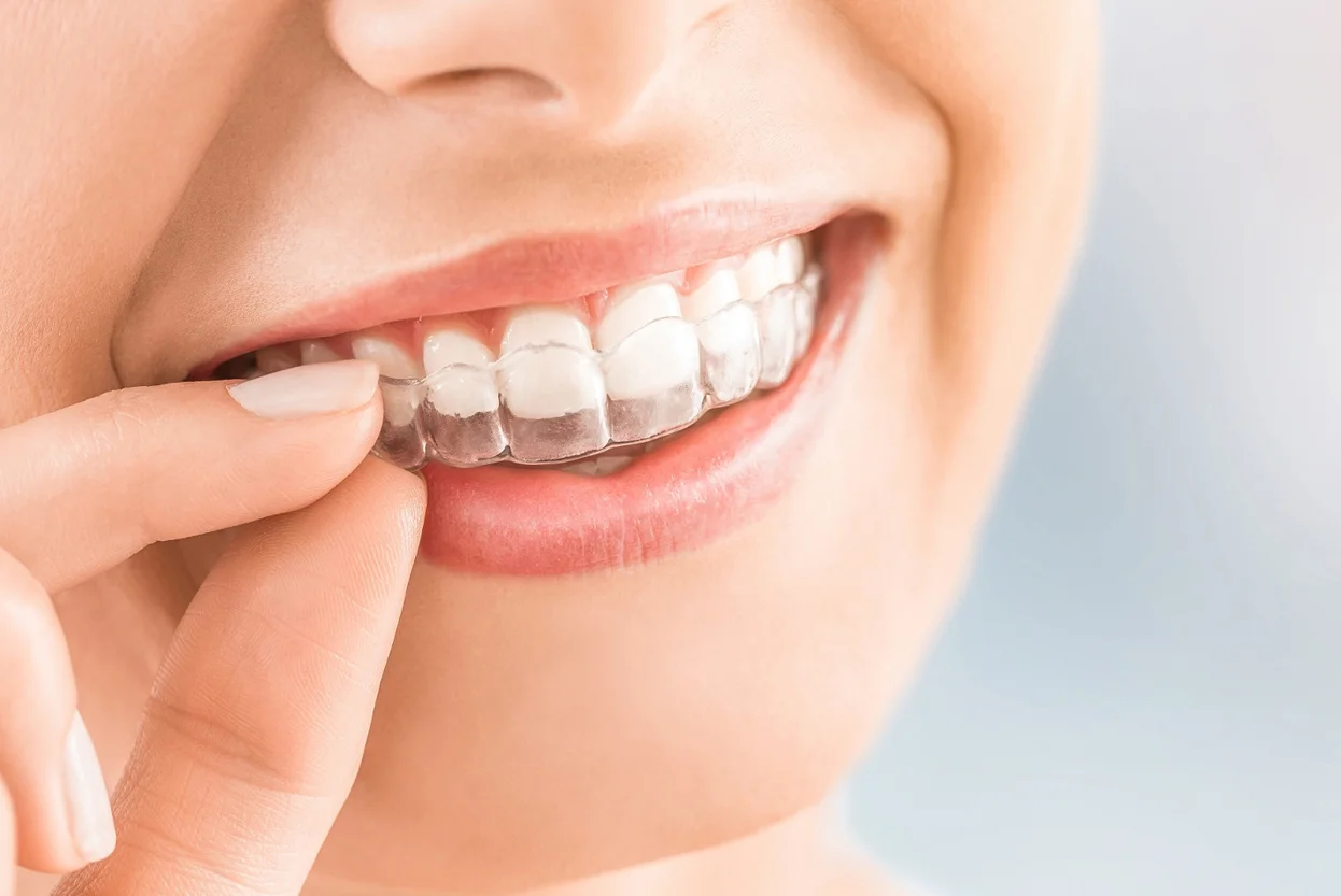 Braces (Invisible Braces)