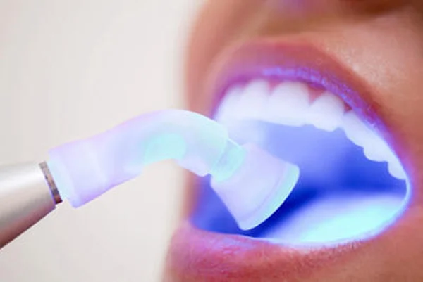 Light Cure Fillings